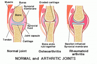 arthritis in joints
