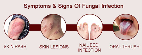 Types of Fungal Infections