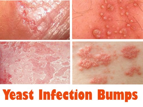 yeast infection rash treatment